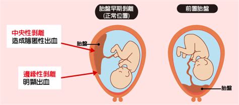 胎盤早期剝離